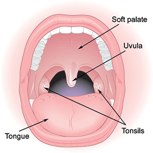 15605-tonsillectomy-overview.jpg